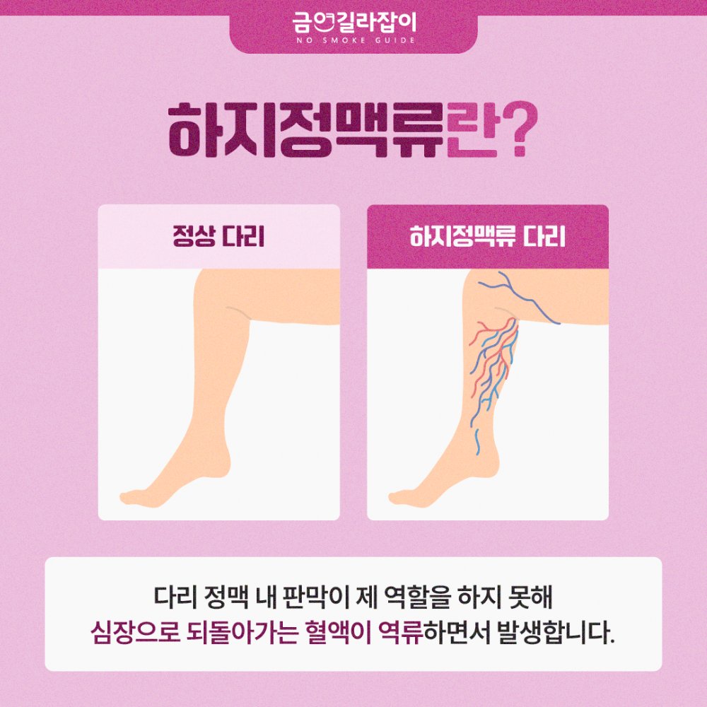 하지정맥류원인(2)